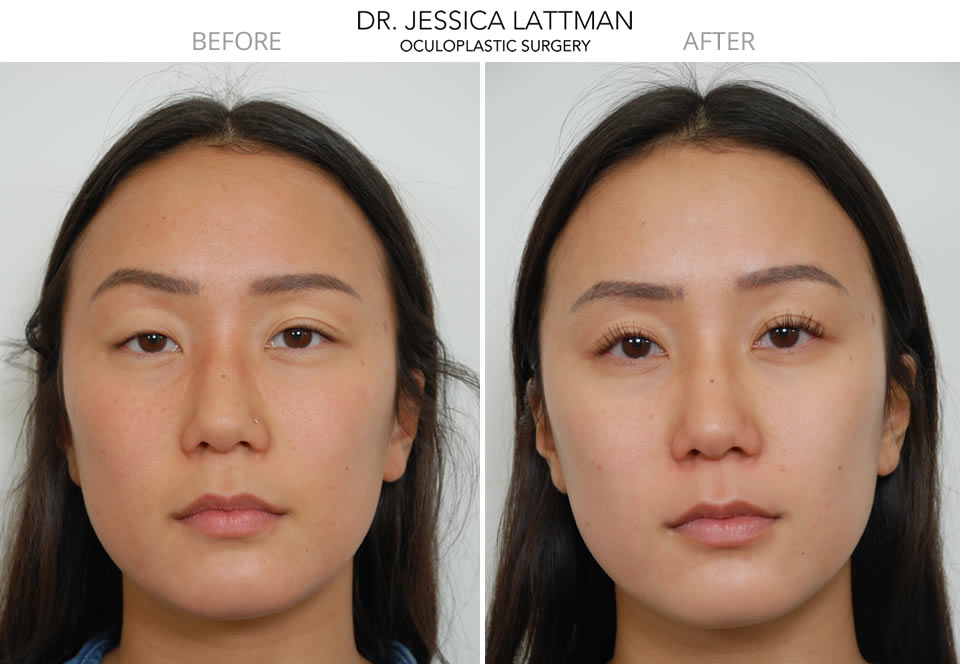 Ptosis clearance of eyelid