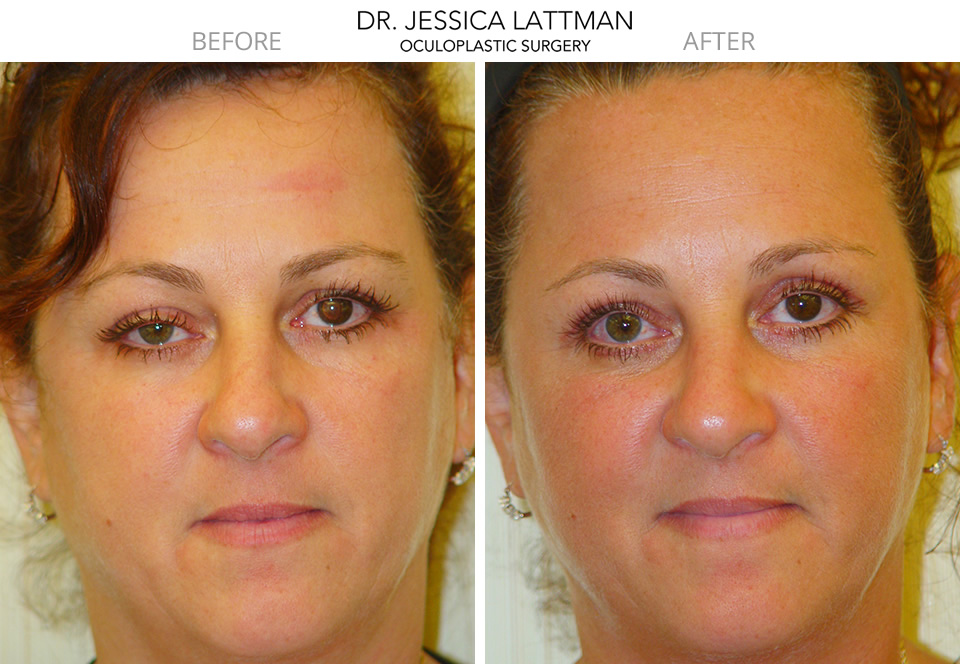 Ptosis Repair By Dr. Jessica Lattman