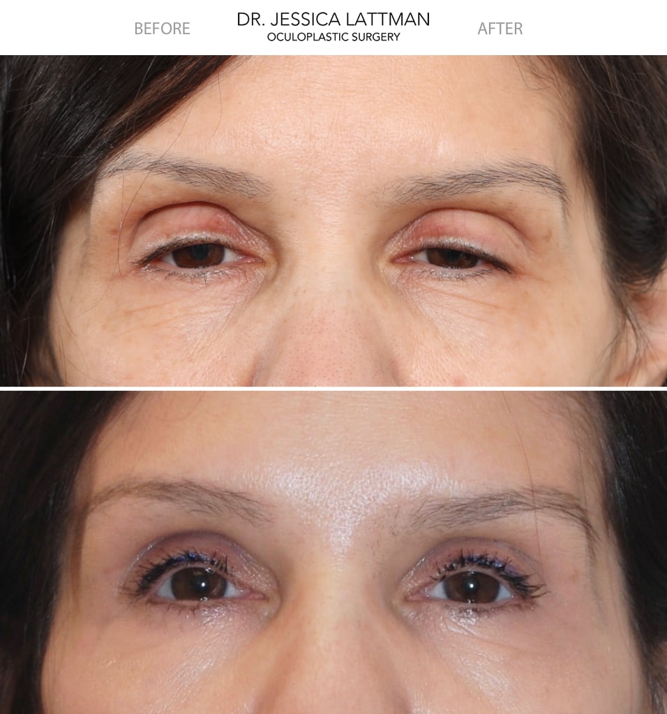 Congenital Ptosis