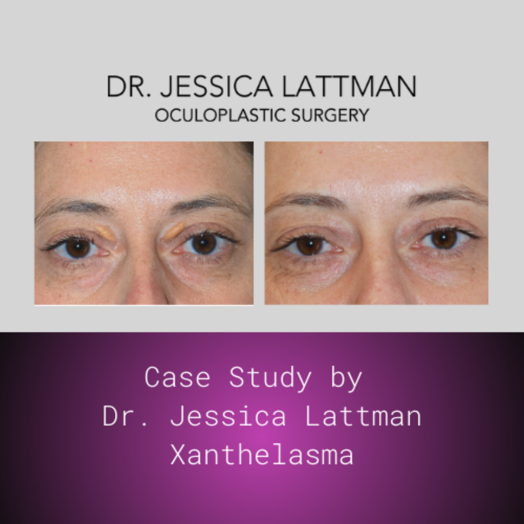 Xanthelasma