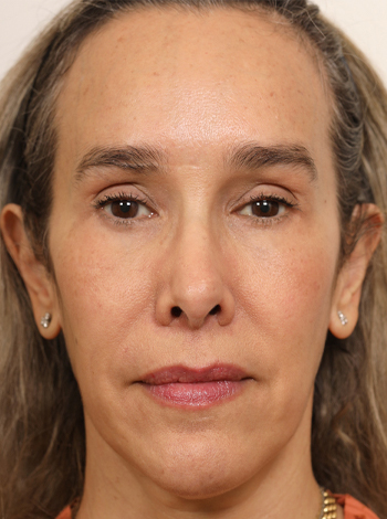 Latmman-Brow Lift-Result2