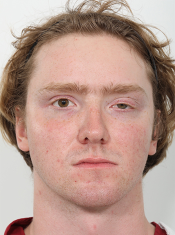 Latmman-Ptosis Result1