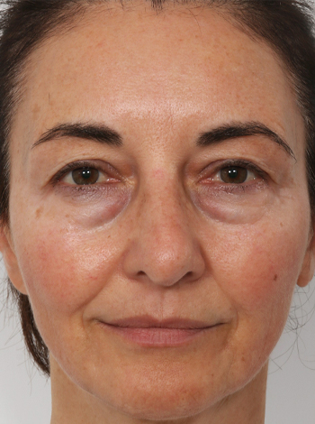 Lattman-Lower-Bleph1