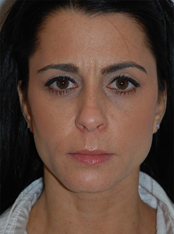 Lattman-Lower-Bleph4