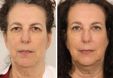 before and after blepharoplasty treatment on a female patient case study by Dr. Jessica Lattman