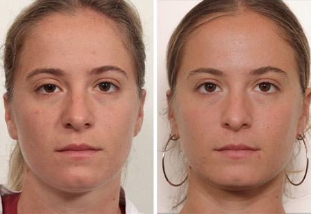before and after ptosis repair female patient front view case study with Dr. Jessica Lattman