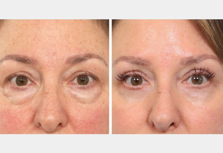 before and after under eye bag correction female patient with Dr. Jessica Lattman