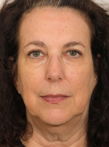 Lattman-Browlift Result4