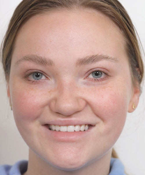 Lattman-Upper Blepharoplasty1