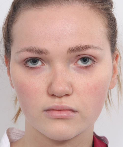 Lattman-Upper Blepharoplasty2