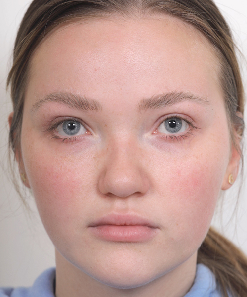 Lattman-Upper Blepharoplasty3