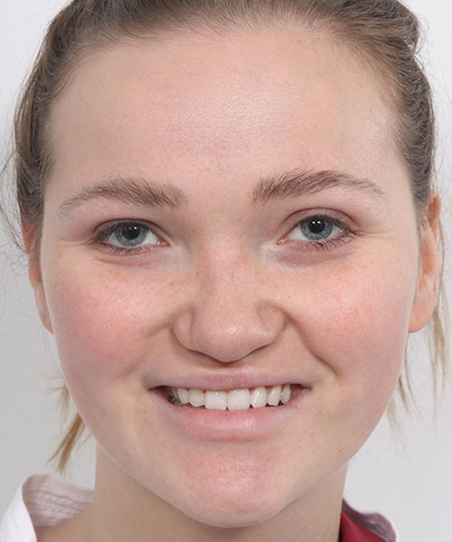 Lattman-Upper Blepharoplasty4