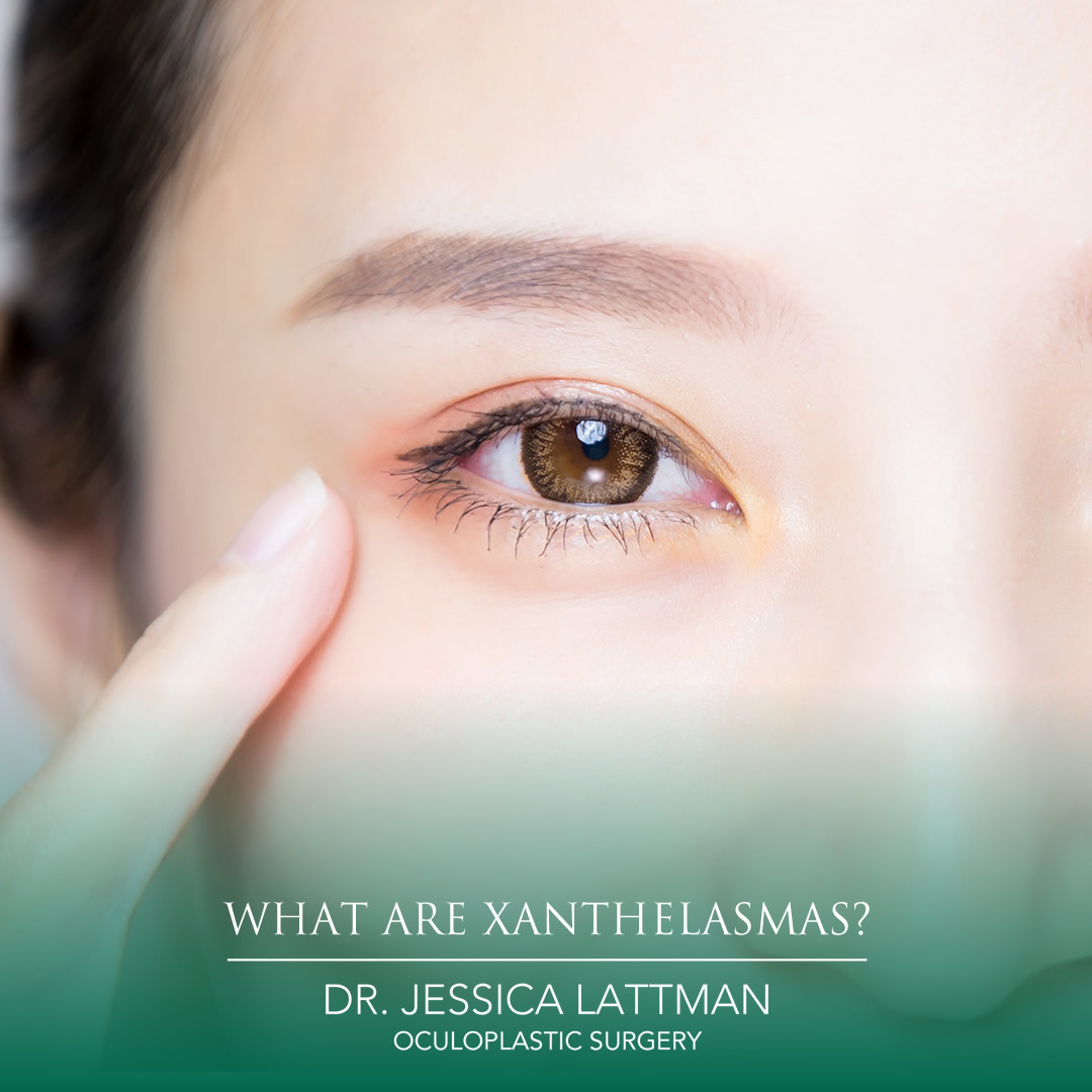 What Are Xanthelasmas?