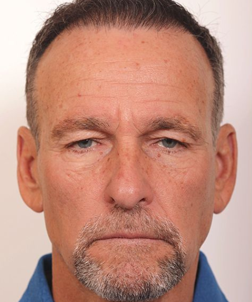 Blepharoplasty and Brow Lift Case 1.1 (1)