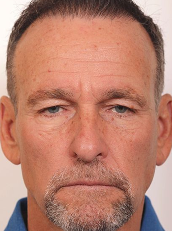 Blepharoplasty and Brow Lift Case 1.1 (3)