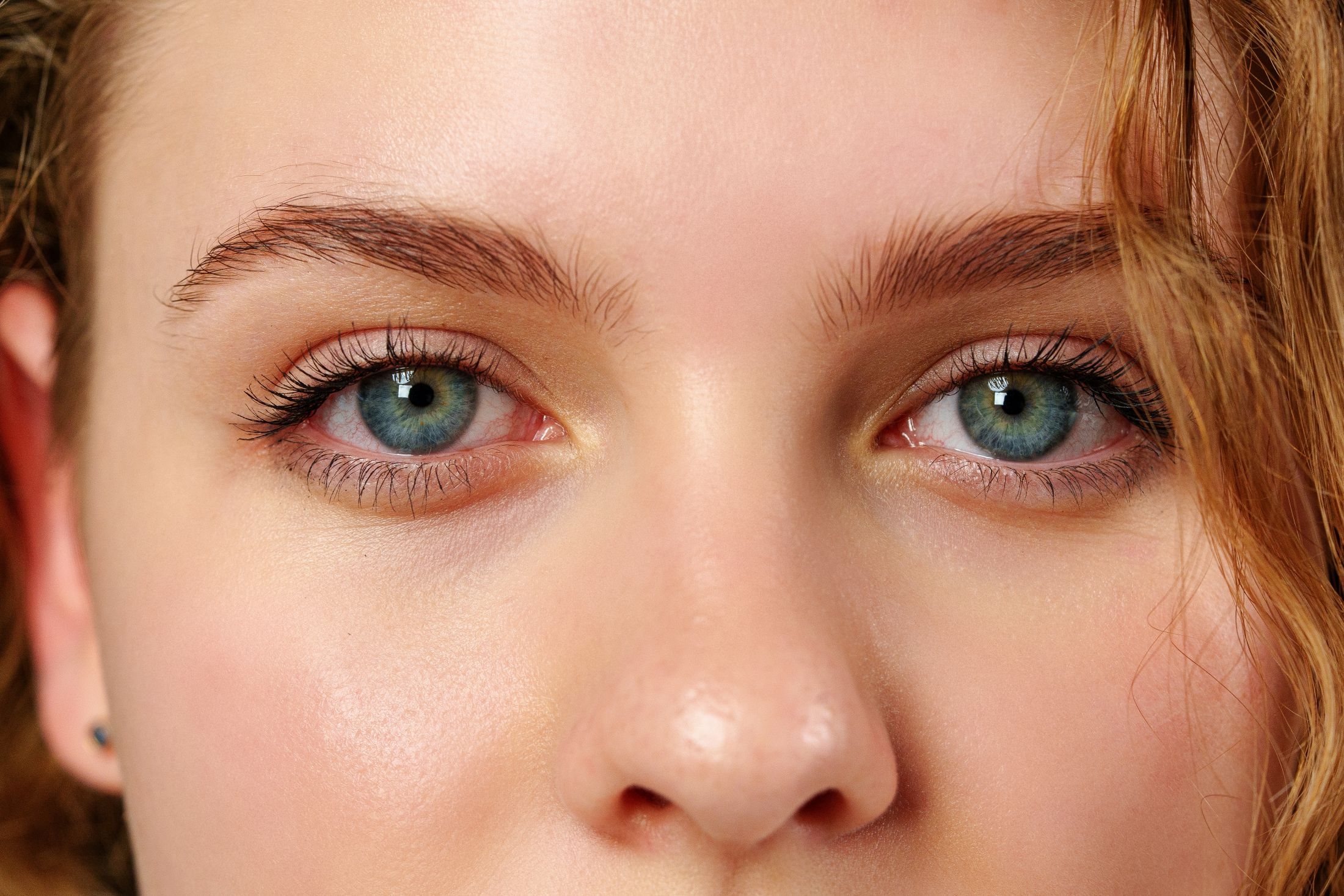 Combining Upper and Lower Blepharoplasty for a Full Eye Rejuvenation