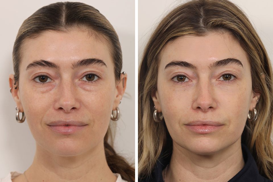 blepharoplasty-facial-fat-grafting--5146