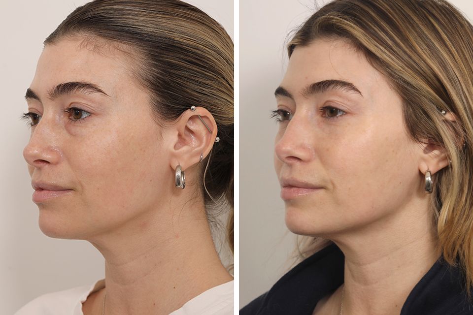 blepharoplasty-facial-fat-grafting--5147